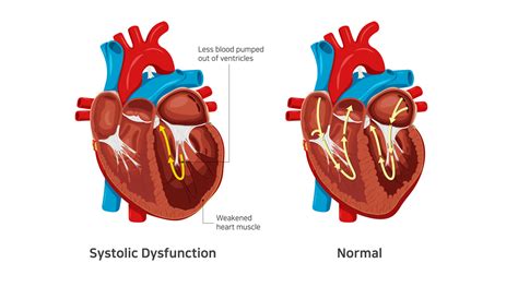 moderate lv dysfunction treatment|severe Lv systolic dysfunction treatment.